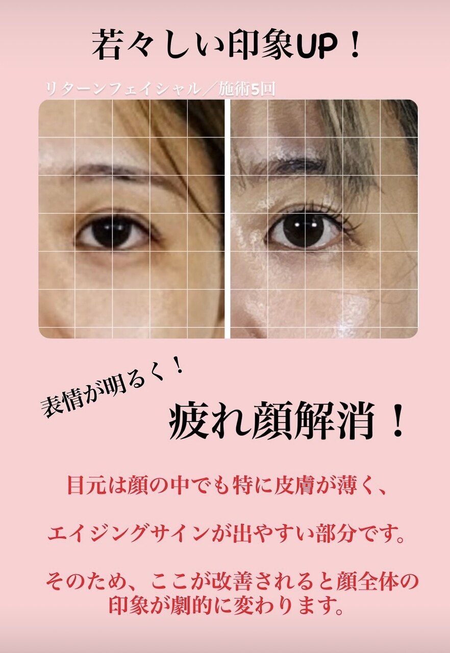レディース全身フル脱毛