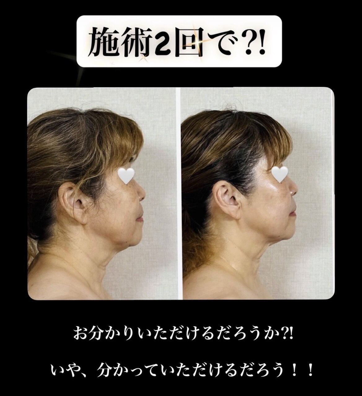 ララピールと毛穴洗浄と光脱毛のフルセット